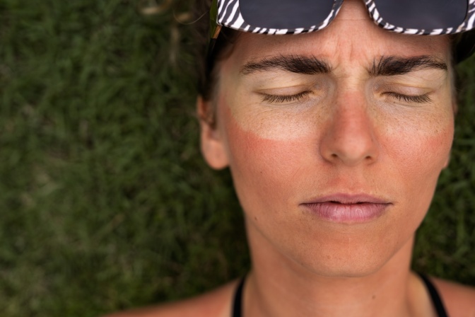 Eine Frau mit geschlossenen Augen und nach oben geschobener Sonnenbrille. Die Haut im Gesicht ist stark gerötet, die Brille hat einen weißen Abdruck hinterlassen.